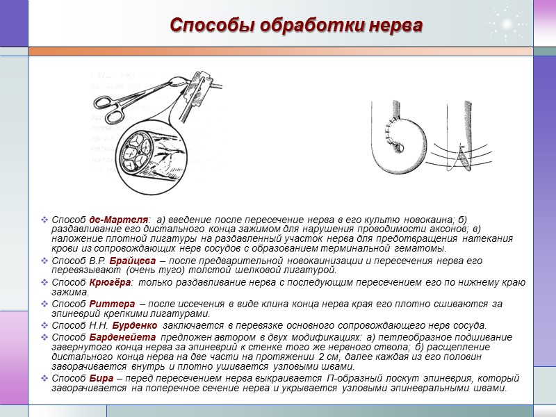 Способы обработки нерва Способ де-Мартеля: а) введение после пересечение нерва в его культю новокаина;